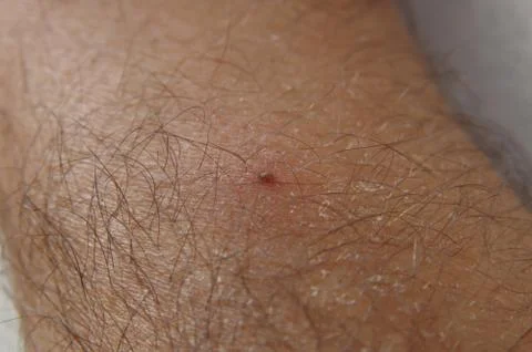 Tick bite arm Stock Photos