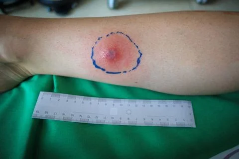 A tick bite has caused abscess on a forearm, a ruler is lying next to it f... Foto stock
