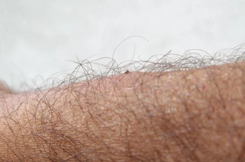 Tick bite on human arm Stock Photos