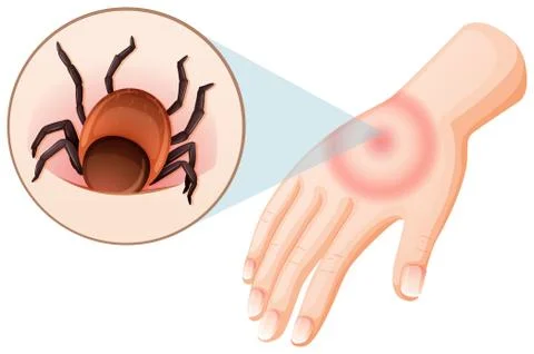 Tick bite human hand Stock Illustration