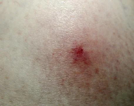 Tick bite marks on the skin Stock Photos