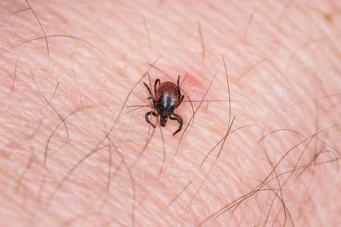 Tick bite Stock Photos