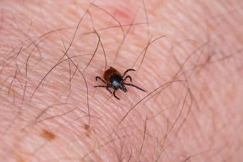 Tick bite Stock Photos