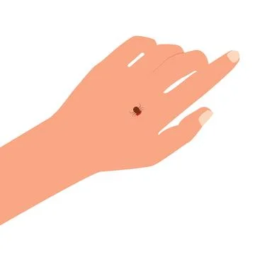 Tick ​​bite. Tick on a human's hand. Healthcare illustration. 스톡 일러스트