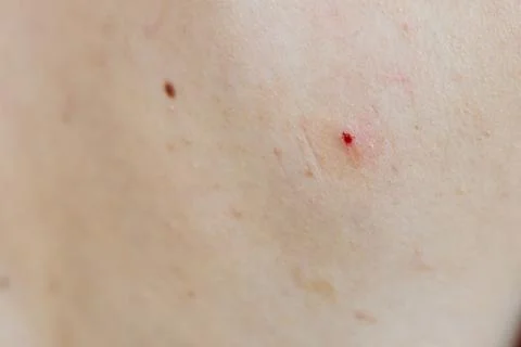 Tick bite wound on back Stock Photos