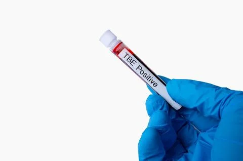 Tick borne Encephalitis Blood Sample Test Tube 스톡 사진