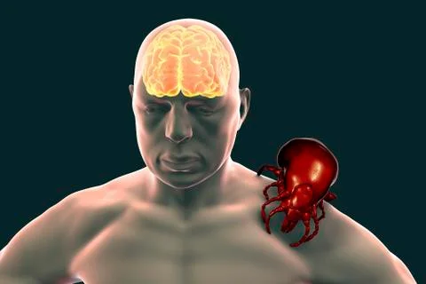 Tick-borne encephalitis concept Stock Illustration