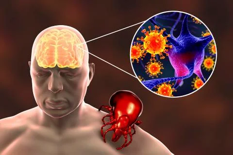 Tick-borne encephalitis concept Stock Illustration
