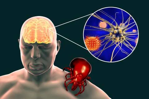 Tick-borne encephalitis concept Stock Illustration