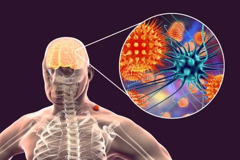 Tick-borne encephalitis concept Stock Illustration