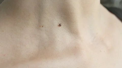 Tick crawling on human Skin Stock-Footage 63922747