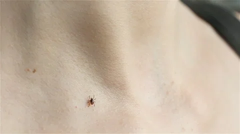 Tick crawling on human Skin Stock-Footage 63922811
