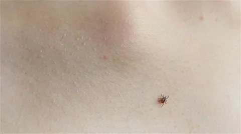 Tick crawling on human Skin Stock Footage 63922831