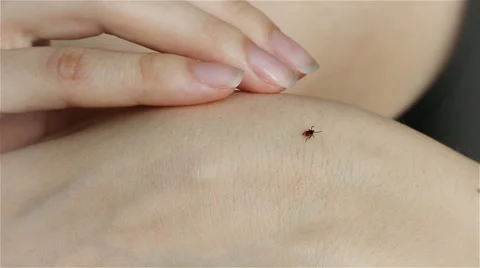 Tick crawling on human Skin 動画素材 63922835