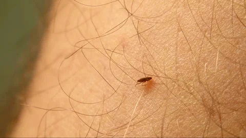 Tick Digs Deeper into Human Skin, Searching for Blood Vessel to Feed Stock Footage 312261356