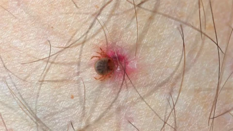 Tick embedded in human skin causing red allergic reaction Stock Footage 271729104