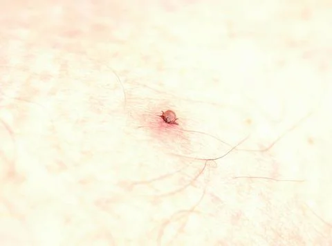 A tick has attached itself to a human leg, macro shot, health care concept... 스톡 사진
