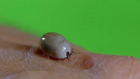 A tick infected with encephalitis crawls over the human body. Stock Footage 199629312