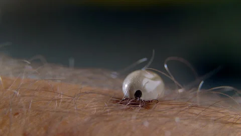 Tick infected with encephalitis or lyme disease is preparing to sting a person Stock Footage 199624725