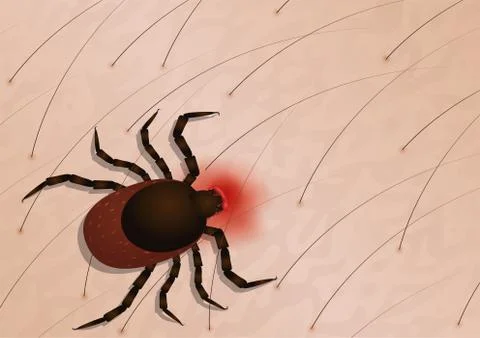 Tick with its head sticking in human skin, red blotches indicate an infection Stock Illustration