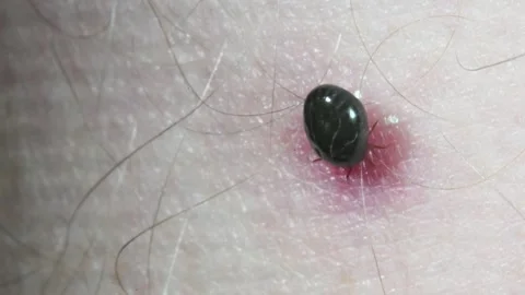 Tick, Ixodes ricinus on the human leg, Ixodes ricinus. Amazzonia, Brasil, Stock Footage 345664160
