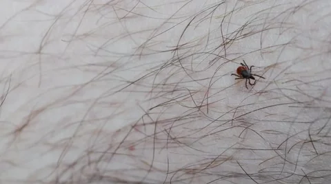 Tick on leg Stock Footage 52750099