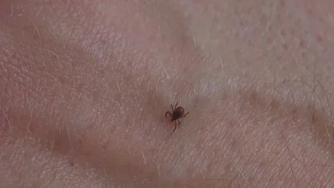 Tick searching on human skin for bite spot symbolizing parasite and disease Stock-Footage 319519945