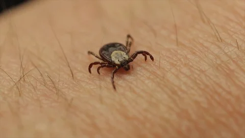 Tick on skin close up. Deer ticks with lyme disease causing health concerns in N Stock Footage 110044252
