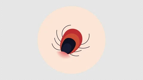 Ticks-insect-bite Stock Footage 276703553