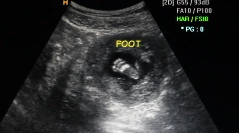 ultrasound on foot