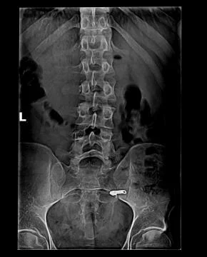 Tilted spine x-ray Stock Photos