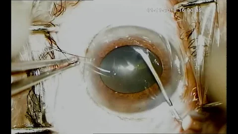 Time lapse  Of Eye Surgery. Surgeon Performing Operation. Closeup. Stock Footage 128213096