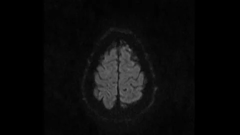 Time lapse of MRI brain scan set, timelapse magnetic resonance imaging of a Stock Footage 316684712