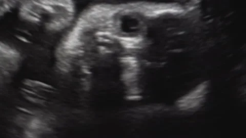 Tiny baby is during 32 weeks turning in mother's belly during ultrasonic proc Stock Footage 132145855