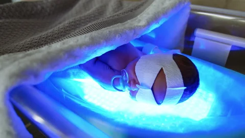 Tiny newborn baby it cured from the childhood jaundice.  Stock Footage 237132783