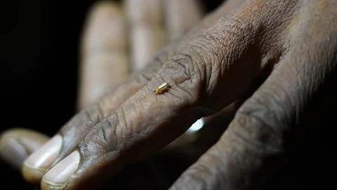 Tiny Parasite on Dark Skinned Hand Medical Dermatology 스톡 사진