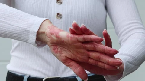 Tips for managing eczema and psoriasis symptoms on sensitive skin at home 스톡 동영상 317717108