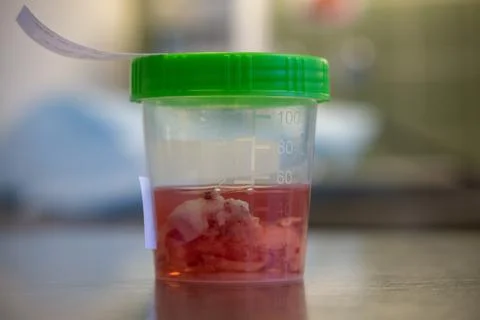 Tissue sample is placed in a formalin-filled cup after an operation Stock Photos