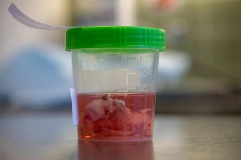 A tissue sample is placed in a formalin-filled cup after an operation Stock Photos