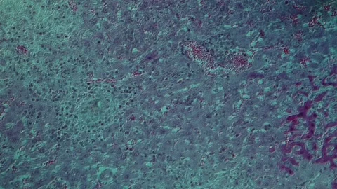 Tissue with schistosomiasis sick tissue Stock Footage 343550261