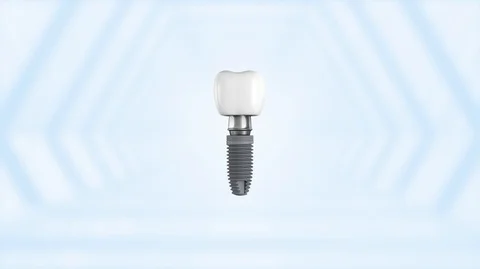 Titanium alloy implant structure description Stock Footage 121986121