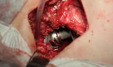 Titanium Hip Head Photos