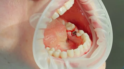Titanium part of a biocompatible implant being installed in the gum and screwed 스톡 동영상 337974788