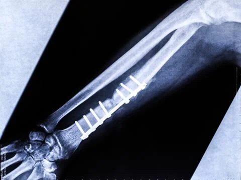 Titanium plate on radius bone in a diagnostic radiograph post surgical operat Stock Photos