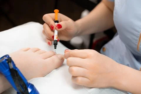 Titanium thread or metal corrective brace on the nail of the big toe sets by Stock Photos