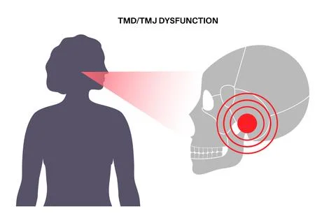 TMD TMJ disorder Stock Illustration