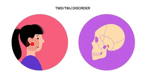 TMD TMJ disorder Stock Illustration