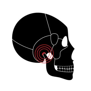 TMD TMJ disorder Stock Illustration