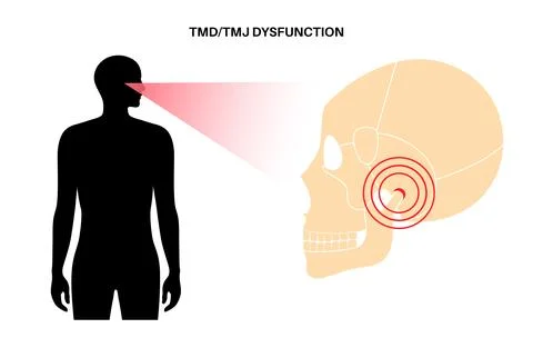 TMD TMJ disorder Illustrazione stock