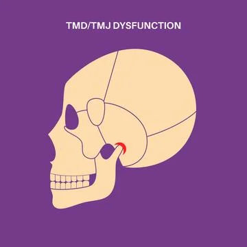TMD TMJ disorder Stock Illustration